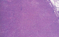 A dog presents with large LNs. Aspirate reveals the above. Dx?


a) Granulomatous Lymphadenitis

b) Caseous Lymphadenitis

c) Suppurative Lymphadenitis

d) Thymic Lymphoma

e) Thymoma

f) Reactive LN

g) Metastatic (Secondary) LN

h) Primary (Lyph...