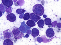 A dog presents with large LNs. Aspirate reveals the above. Dx?


a) Granulomatous Lymphadenitis

b) Caseous Lymphadenitis

c) Suppurative Lymphadenitis

d) Thymic Lymphoma

e) Thymoma

f) Reactive LN

g) Metastatic (Secondary) LN

h) Primary (Lyph...