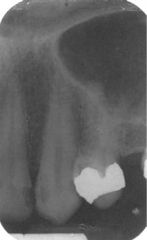 radiopaque curve at top of x-ray
