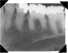 radiopaque line below second molar