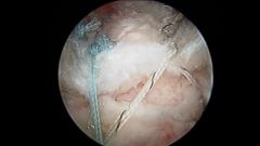 68yo F R-hand dom c/o R shoulder injury Fig, denies shoulder pain prior to a fall @ work after slipping on some water 4 wks ago, smokes 1/2 ppd. Which characteristics of this pt confer the >est risk of not healing p/surgical repair?  1-1/2 ppd smo...