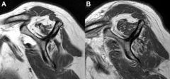 Pt age older> 65 is the highest risk factor for nonhealing of the surgically repaired rotator cuff, Advanced fatty infiltration & mus atrophy on MRI & sign glenohumeral DJD are relative contraindications for rotator cuff repair.Ans4