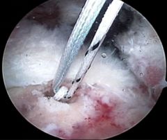 Suture anchor drilling into hum head has been shown to > vascularity response during RCR,  peribursal tissue and bone anchor site were the main conduits of blood flow for the rotator cuff tendon. Blood flow of repaired RCT < w/time, but exercise s...