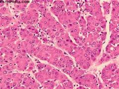 Identify the lesion seen in this liver