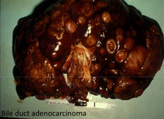 Bile duct carcinoma (gross image left)

Note loss of lobules