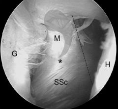 Which of the following may be seen during scopy in a pt w/subscapularis tear? 1-Uncovered lesser tub; 2-Retraction subscapularis tendn to the level of the glenoid; 3-Avulsed superior glenohumeral lig; 4-Med biceps subluxation; 5-All of the above