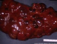 Identify the lesion seen in this liver
