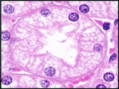 - High cuboidal epithelium
- Indistinct cell borders
- Few basally located nuclei
- Eosinophilic, granular cytoplasmic staining