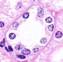 - Low cuboidal epithelium
- Indistinct cell borders
- Many, centrally located nuclei
- Pale staining cytoplasm