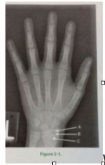 What is the portion of bone labeled C in pediatric PA hand image in fig 2-1
A. Diaphysis
B. Epiphysis
C. Metaphysis
D. Apophyseal