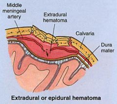 extradural/epidural hematoma