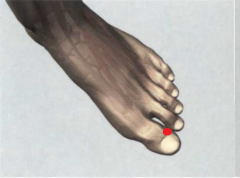 0,1 Tsun proximal y lateralmente hasta el ángulo ungueal externo del dedo gordo del pie