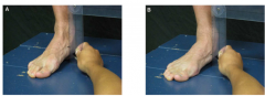 The distance the navicular tuberosity moves in standing as the subtalar joint is allowed to move from its neutral to relaxed position 
 
Get the person to stand. Then palpate the talus and adjust foot till feel equal medial and lateral heads and s...