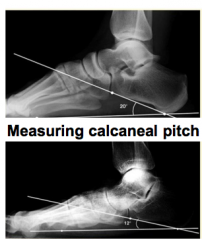 Looking at calcaneal pitch 
 
"Pitch" = inclination off the calcaneous