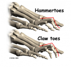 Hammer toe is differnet than claw toe because the distal interphalangeal joint is extended as opposed to flexed