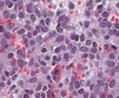 Which bone pathology is associated with anaplastic, malignant small blue cells?