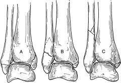 syndesmosis
delatoid ligament laterally
anterior talo fibular ligament medially

webber A,B,C

type A
-below level of the ankle joint
-tibiofibular syndesmosis intact
-deltoid ligament intact
-medial malleolus often fractured
usually st...
