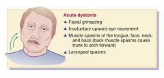 The symptoms of acute dystonia usually occur in 5% of clients within days of taking typical antipsychotics. Characteristics of the reaction include muscle spasms of face, tongue, neck, and back; facial grimacing; abnormal or involuntary upward eye movemen