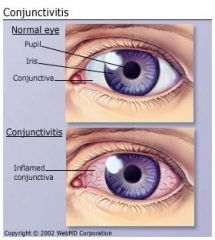 Inflammation or infection of conjunctiva

Usually viral, maybe bacterial, allergic
--tearing, burning, itching, edema, discharge

“Pink eye”

Antibiotic drops or ointments

Warm compresses

Excellent hand washing

Highly contagious (if infect