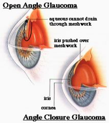 Primary Open Angle Glaucoma (90% of cases) 

Outflow disturbance
--Fluid normally regulated by constant formation & reabsorption of aqueous humor
--↓ aqueous outflow & ↑ intraocular pressure

↑ IOP → slow optic to degeneration → slow, deteriorating 