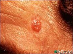 --Most common & least deadly
--Sun exposed skin
--Slow growing & invades local tissue
--Metastasis rare
--Middle to older adults
--Slow enlarging papule with pearly appearance, slight erythema, & translucent border
--Excisional surgery