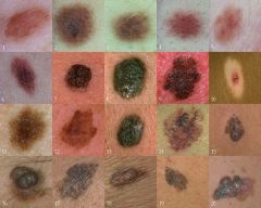 1/3 exist occur in existing nevi or moles

In women, melanoma occurs in lower legs

In men, melanoma occurs on trunk, head & neck

Melanin causes tumors to most often be brown or black

ABCDE assessment
--Asymmetry – one side does not match the o