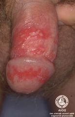 Generally genital infections

Increasing number of genital herpes cases are attributable to HSV-1

Clinical manifestations and treatment same as herpes 1