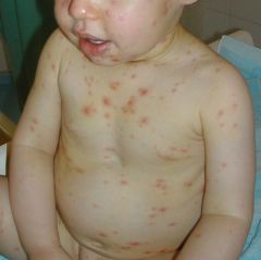 The primary infection which causes chicken pox and later herpes zoster (shingles) in adults

Immunization