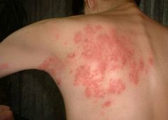 Herpes zoster (shingles), also known as varicella zoster, is caused by reactivation of the dormant varicella-zoster virus (VZV) in patients who have previously had chickenpox. The dormant virus resides in the dorsal root ganglia of the sensory nerves. The