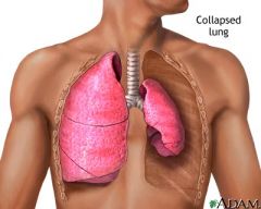 The collapse of alveoli or a lobule or larger lung unit

Etiology: 

Airway obstruction of bronchus
--Impedes passage of air to and from the alveoli
----Air is trapped & absorbed into the blood stream
----External communication is blocked, replacem