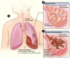 Symptoms are similar to other types of pneumonia:

Fever, chills, productive cough, Pleuritic chest pain

Confusion, hypoxia

Diminished breath sounds

Crackles, sonorous & sibilant wheezing

Altered respiratory pattern (Tachypnea)

Abnormal c