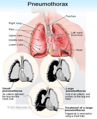 Pneumothorax
--Presence of air or gas in pleural space that causes lung collapse

Tension pneumothorax
--Occurs when air enters pleural space during inspiration thru 1 way valve caused by blunt chest trauma & can’t exit upon expiration
--↑ pressure c