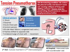 Tension pneumothorax, a rapidly developing and life-threatening complication of blunt chest trauma, results from an air leak in the lung or chest wall. Air forced into the chest cavity causes complete collapse of the affected lung. Air that enters the ple