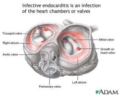 Microbial infection involving the endocardium

Those at high risk:
--IV drug abusers
--Valve replacement recipients
--People who have had systemic infections
--People with structural cardiac defects

Possible ports of entry
--Oral cavity
--Skin 