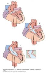 Perform in the Invasive Cardiac Lab
Femoral artery approach
Pre & post-op management similar to PCI patients