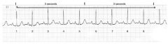 Each segment between the dark lines (above the monitor strip) represents 3 seconds when the monitor is set at a speed of 25 mm/sec. To estimate the ventricular rate, count the QRS complexes in a 6-second strip and then multiply that number by 10 to estima