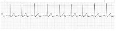 Rate: 60-100 beats/min

Rhythm: regular

P waves: Present, consistent configuration, one P wave before each QRS complex

PR interval : 0.12-0.20 second and constant

QRS duration: 0.04-0.10 second and constant