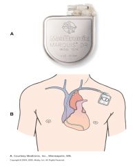 Treatment for life-threatening ventricular arrhythmias 

Lead system placed via subclavian vein to endocardium

Pulse generator is implanted over pectoral muscle