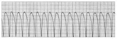 Ventricular Tachycardia

Ventricular tachycardia (VT), sometimes referred to as “V tach,” occurs with repetitive firing of an irritable ventricular ectopic focus, usually at a rate of 140 to 180 beats/min or more (Fig. 36-11). VT may result from increas