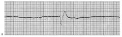 Ventricular asystole, sometimes called ventricular standstill, is the complete absence of any ventricular rhythm (Fig. 36-12, B). There are no electrical impulses in the ventricles and therefore no ventricular depolarization, no QRS complex, no contractio