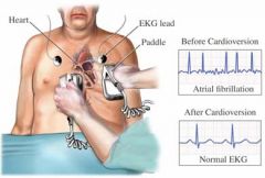 Cardioversion is a synchronized countershock that may be performed in emergencies for unstable ventricular or supraventricular tachydysrhythmias or electively for stable tachydysrhythmias that are resistant to medical therapies. If the patient has been ta