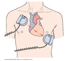 Defibrillation, an asynchronous countershock, depolarizes a critical mass of myocardium simultaneously to stop the re-entry circuit, allowing the sinus node to regain control of the heart.

Continue effective CPR until a defibrillator is available. The 