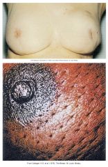 --Single lump, mass, or mammographic abnormality
--Painless, hard, irregular edges > likely to be cancerous
--Can also be tender, soft or rounded
--Orange peel appearance
--Swelling of all or part of a breast
--Skin irritation or dimpling
--Breast o
