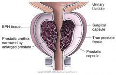Glandular units in the prostate that undergo an increase in number of cells, resulting in enlargement of prostate gland