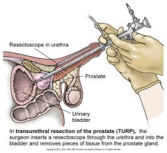 Transurethral resection of prostate (TURP)

Prostatectomy
--Suprapubic
--Retropubic
--Perineal