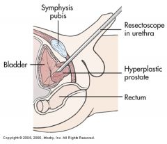 TURP

Indications:
--Decrease in urine flow sufficient to cause discomfort
--Persistent residual in urine
--Acute urinary retention
--Hydronephrosis

Transurethral Resection of Prostrate (TURP)
--Choice for debilitating patient with moderate pros