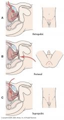 Suprapubic Prostatectomy:
--Pt has co-existing problems
--Suprapubic catheter & Foley catheter is inserted
----Foley catheter is removed 2-4th postoperative day
----Suprapubic tube has a greater risk for bladder spasms
----Monitor frequently for urin