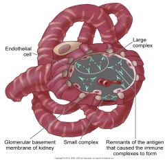 --Immunologic processes involving the urinary tract predominantly affect the renal glomerulus
--Inflammation of the renal glomeruli

Classifications:
--Extent of damage (Diffuse or focal)
--Initial cause of the disorder (SLE, scleroderma, strep infec
