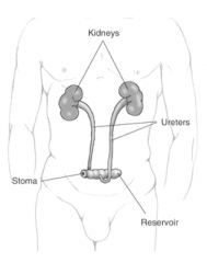 --Ileal conduit (ileal loop), most common type: 6-8 inches of ileum are converted into a conduit for urinary diversion
--Ureters are anastomosed into one end of the conduit, and other end of the bowel is brought out to the abdominal wall to form a stoma
