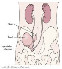 --Intra-abdominal reservoir that is catheterizable or has an outlet controlled by anal sphincter
--Internal pouches created similar to ileal conduit
--Reservoirs from ileum, ileocecal segment or colon, e.g., Kock pouch
--Continence mechanism formed bet